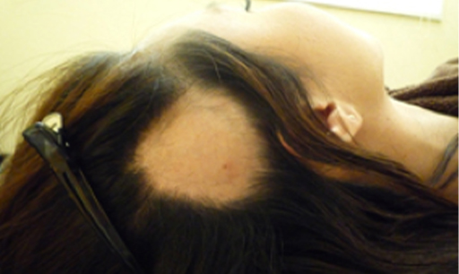 円形脱毛症の鍼灸治療